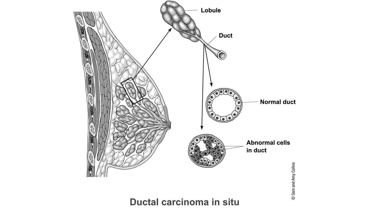 Rethinking automatic mastectomies for lowgrade, stage 0 breast cancer