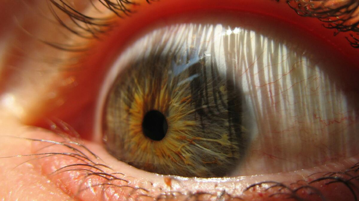 14 worms pulled from Oregon woman's eye after rare infection